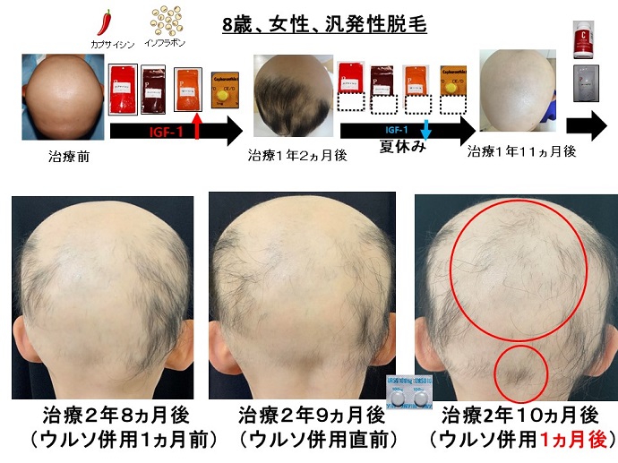 円形脱毛症　病院